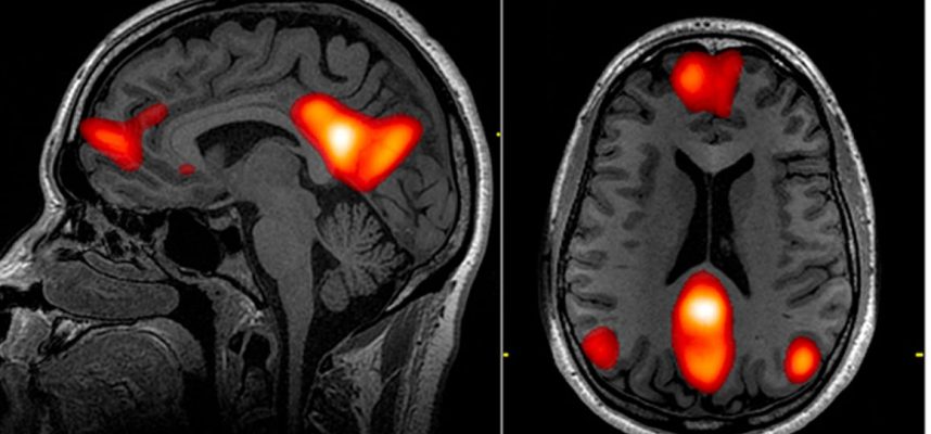 Сканирование мозга показывает полный спектр аномалий COVID-19, которые не могут объяснить ученые